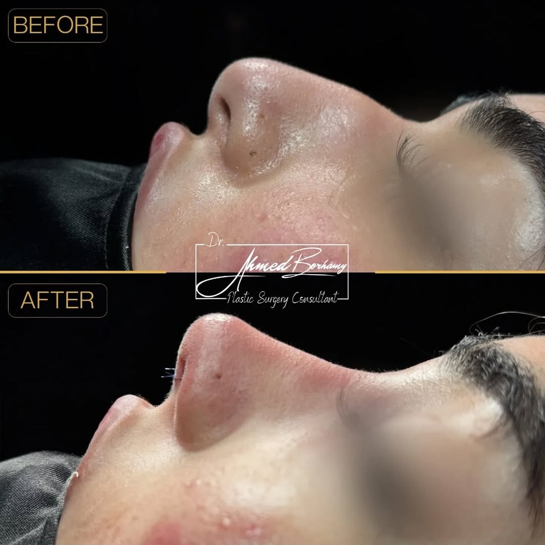 Rhinoplasty result by Dr. Ahmed Borhamy