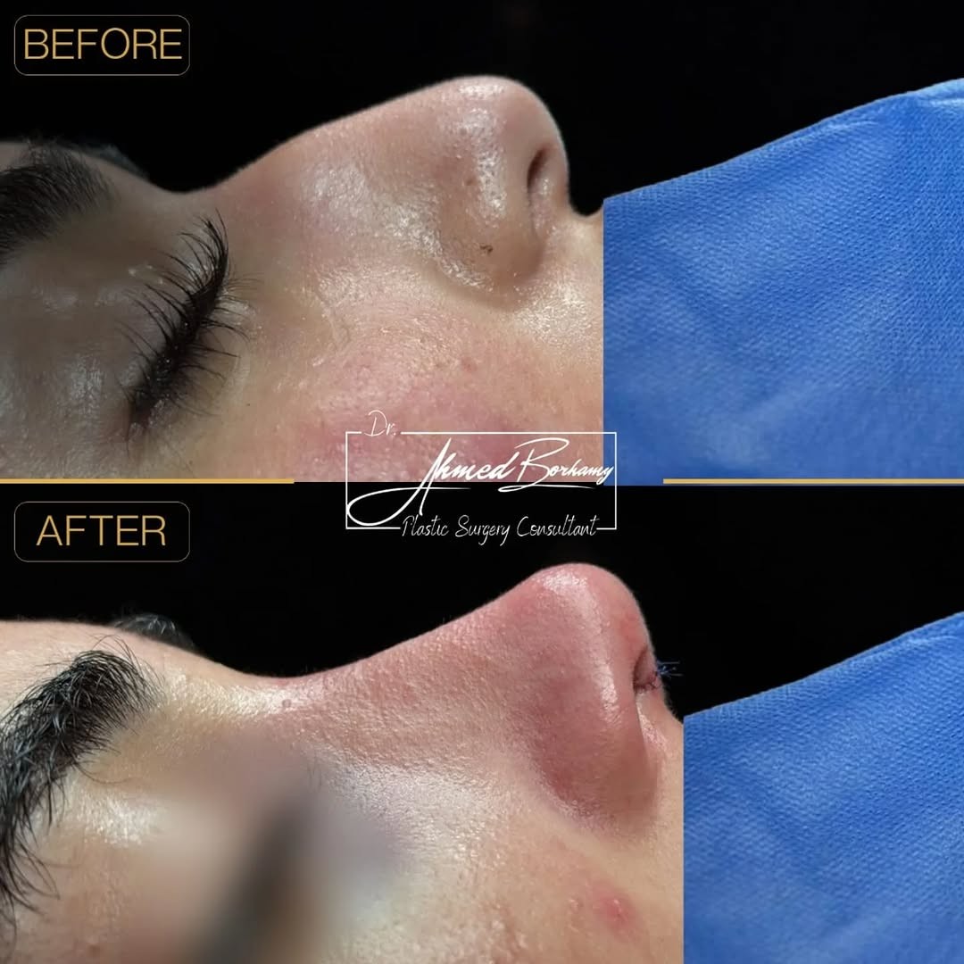 Rhinoplasty result 2 by Dr. Ahmed Borhamy