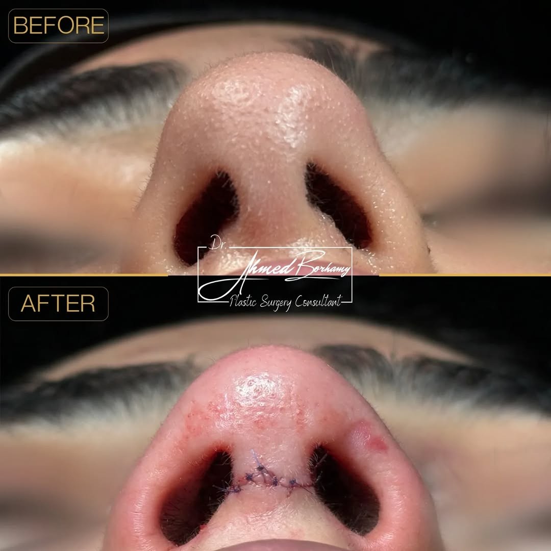 Rhinoplasty result 3 by Dr. Ahmed Borhamy