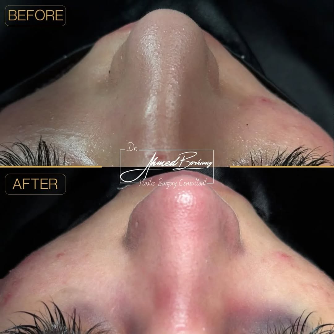 Rhinoplasty result 4 by Dr. Ahmed Borhamy