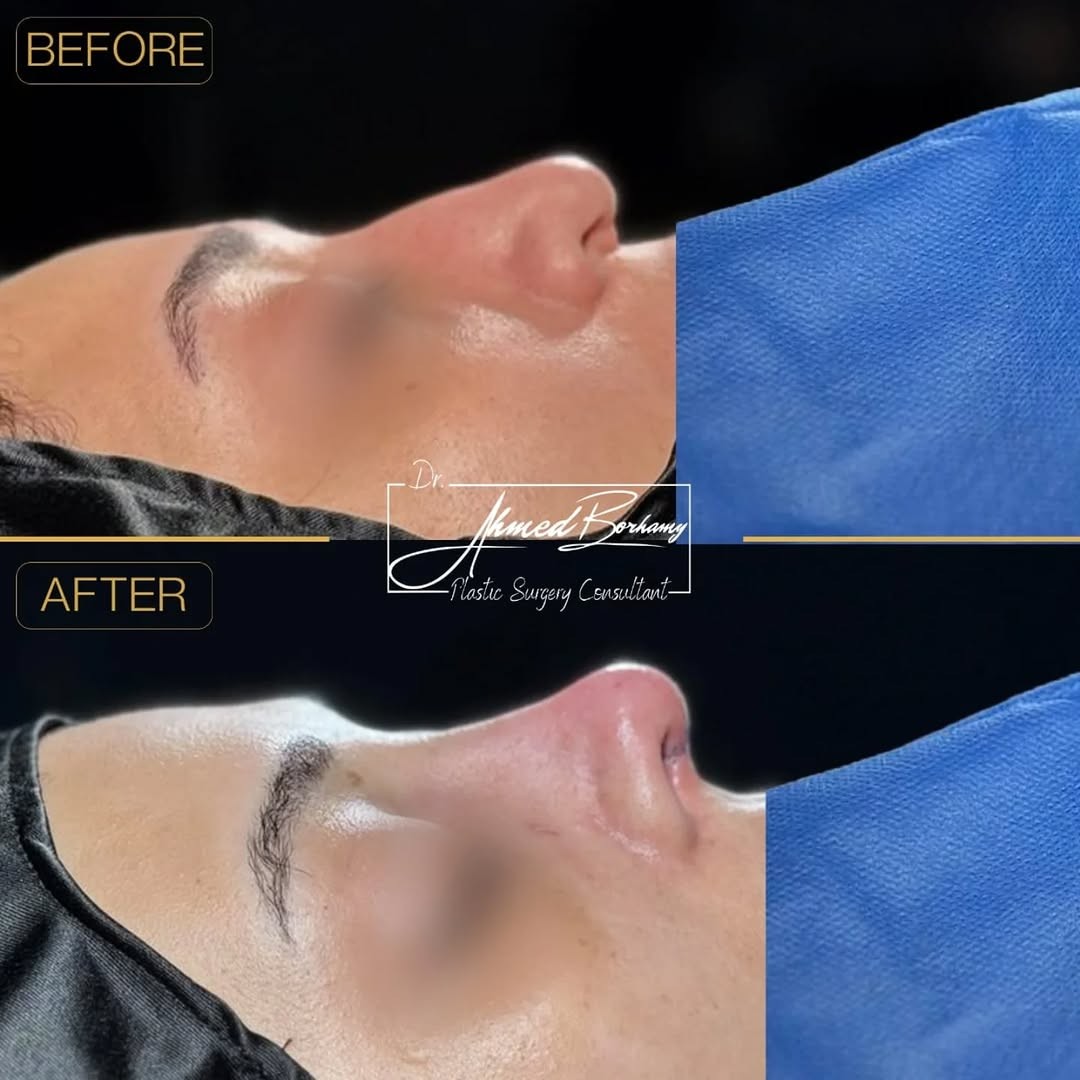 Rhinoplasty result 5 by Dr. Ahmed Borhamy
