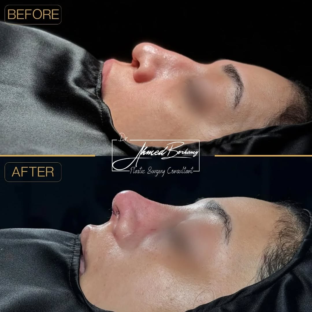 Rhinoplasty result 6 by Dr. Ahmed Borhamy