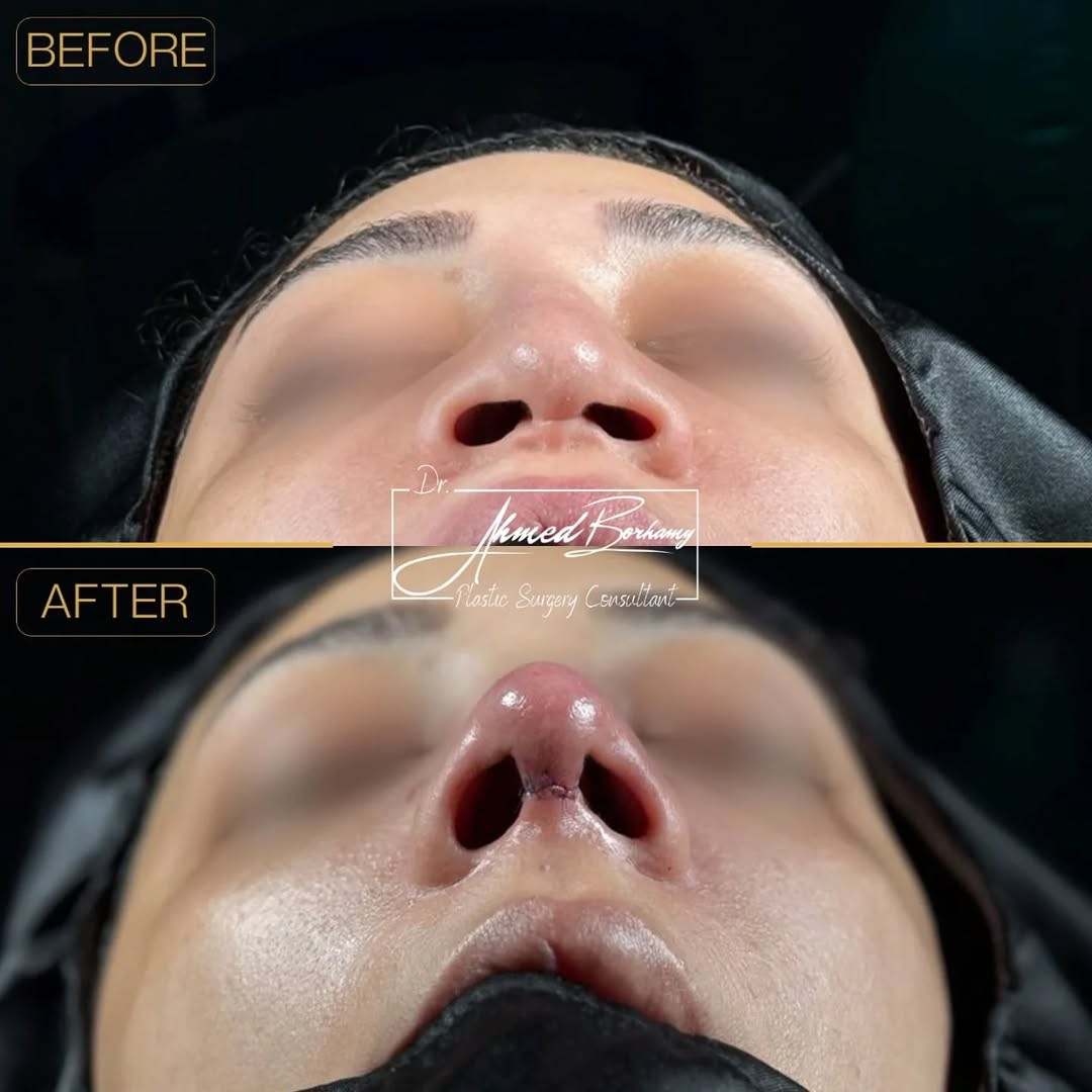 Rhinoplasty result 7 by Dr. Ahmed Borhamy