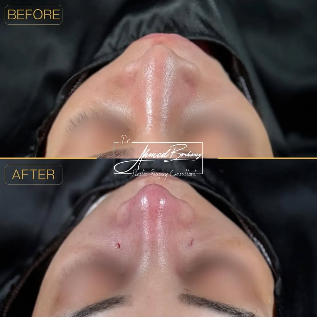 Rhinoplasty result 8 by Dr. Ahmed Borhamy